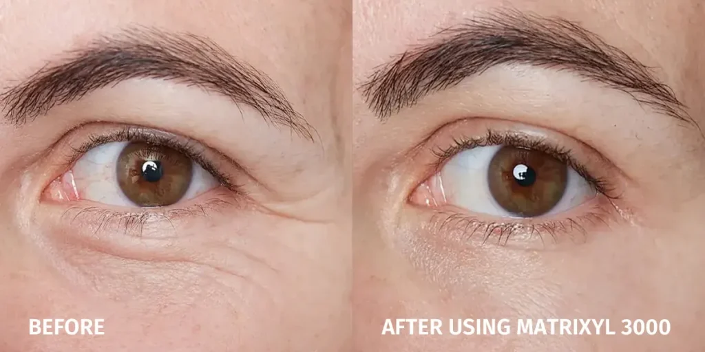 使用 Matrixyl 3000 前后对比