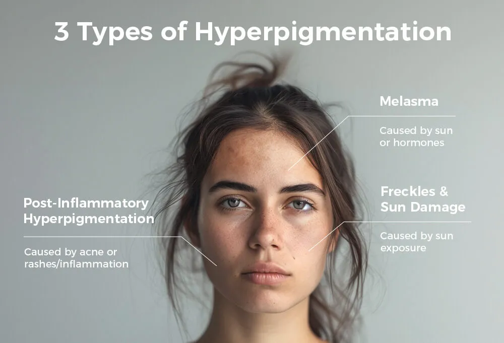3种类型的色素沉着
