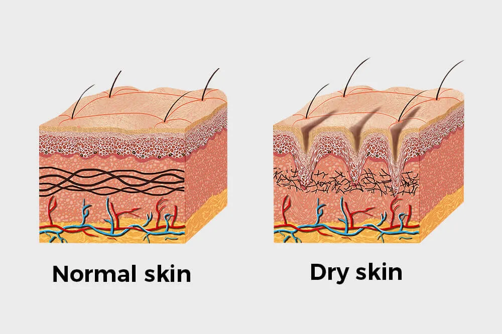 干性皮肤 vs 正常皮肤