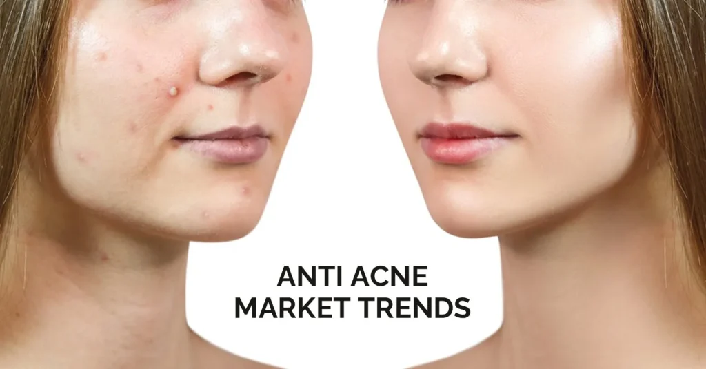 Anti Acne Market Trends
