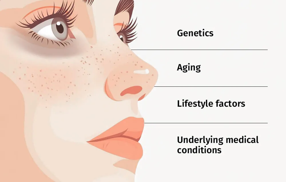 黑眼圈的形成原因