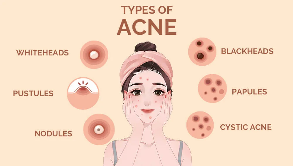 痤疮的类型