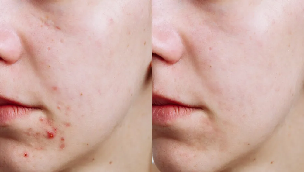 抗痘前后对比