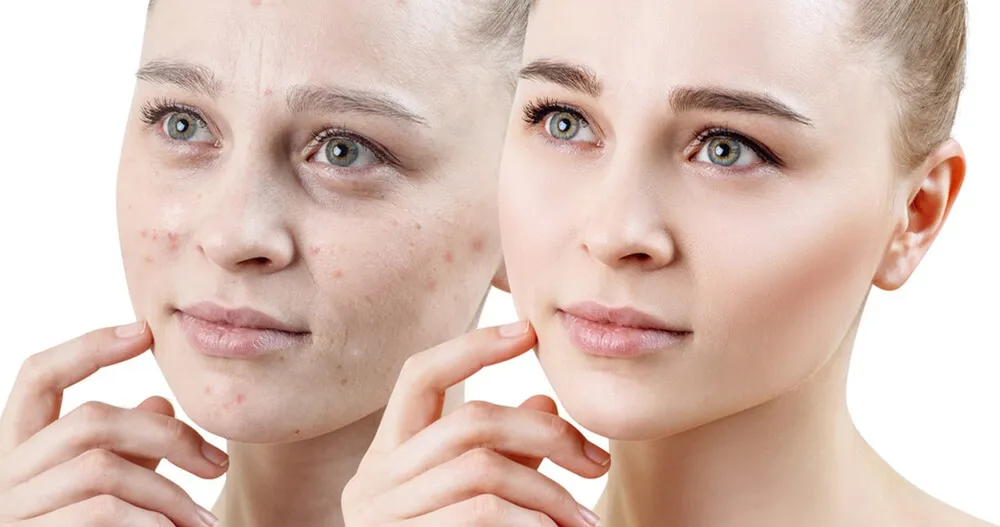 自有品牌抗痘产品