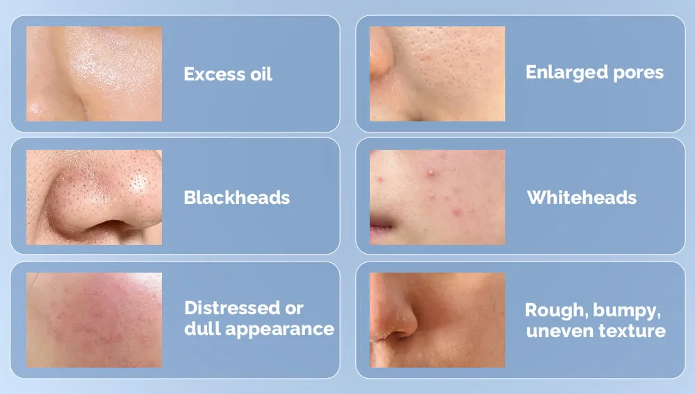 毛孔堵塞对皮肤的影响