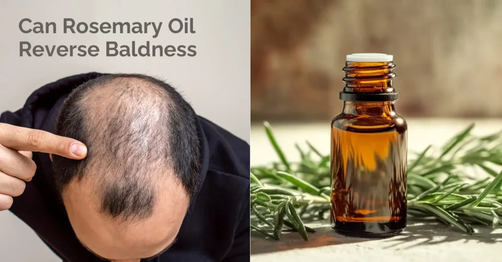 Can Rosemary Oil Reverse Baldness