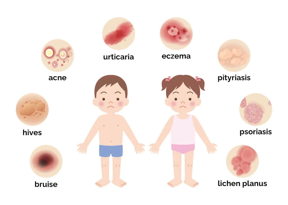 儿童独特的皮肤问题