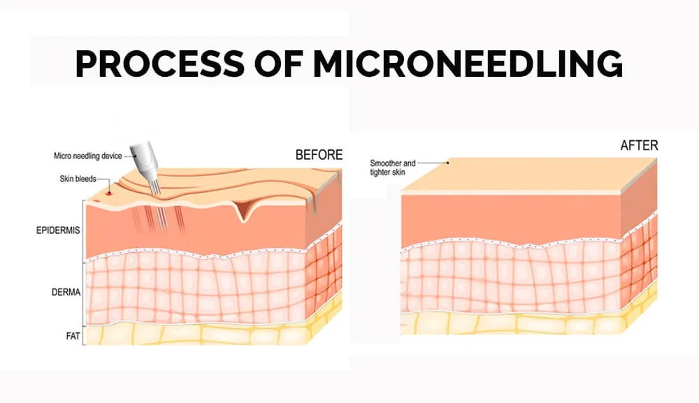 结合外泌体的微针疗法的步骤