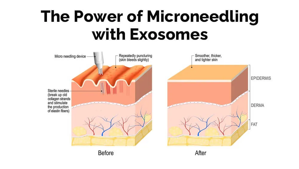 结合外泌体的微针疗法