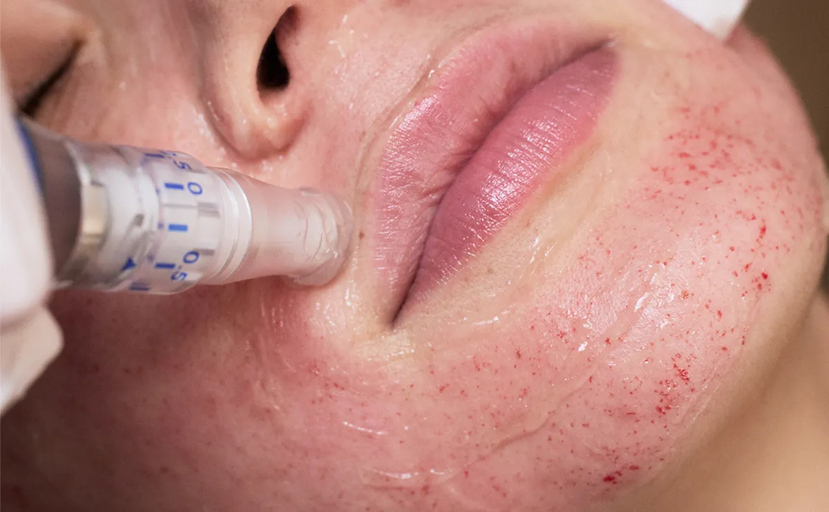 Microneedling