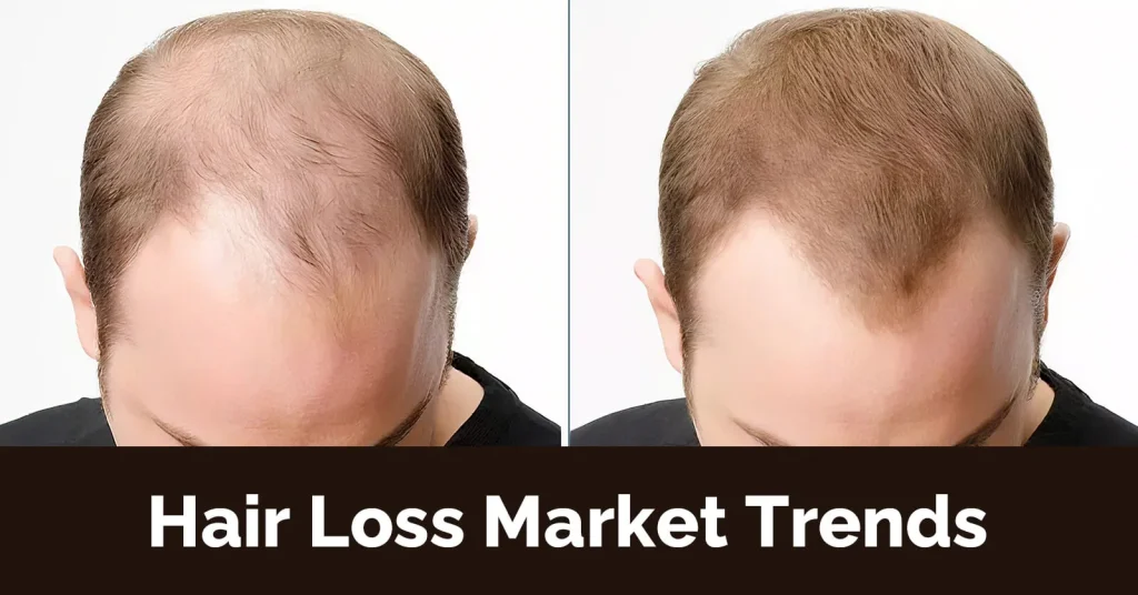 Hair Loss Market Trends