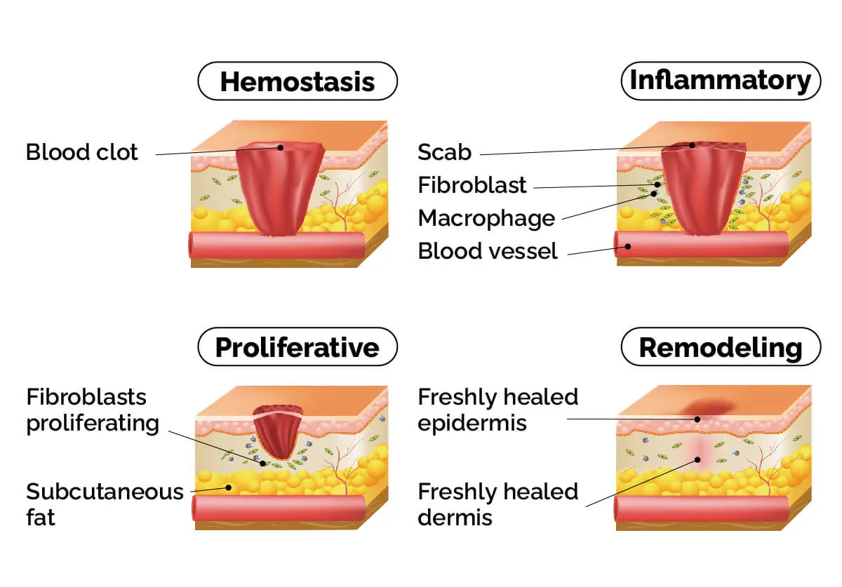 伤口愈合的4个阶段