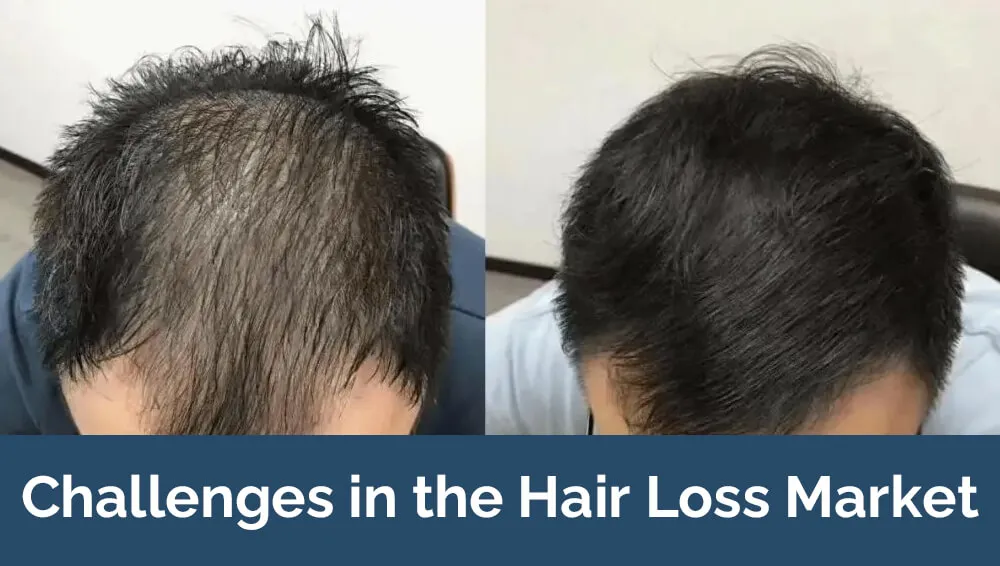 脱发市场面临的挑战