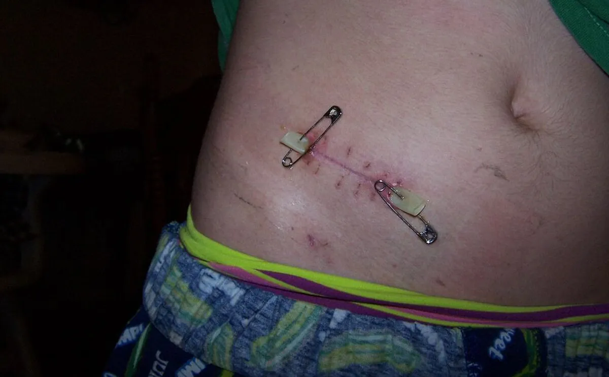 Appendectomy (Appendix Removal)