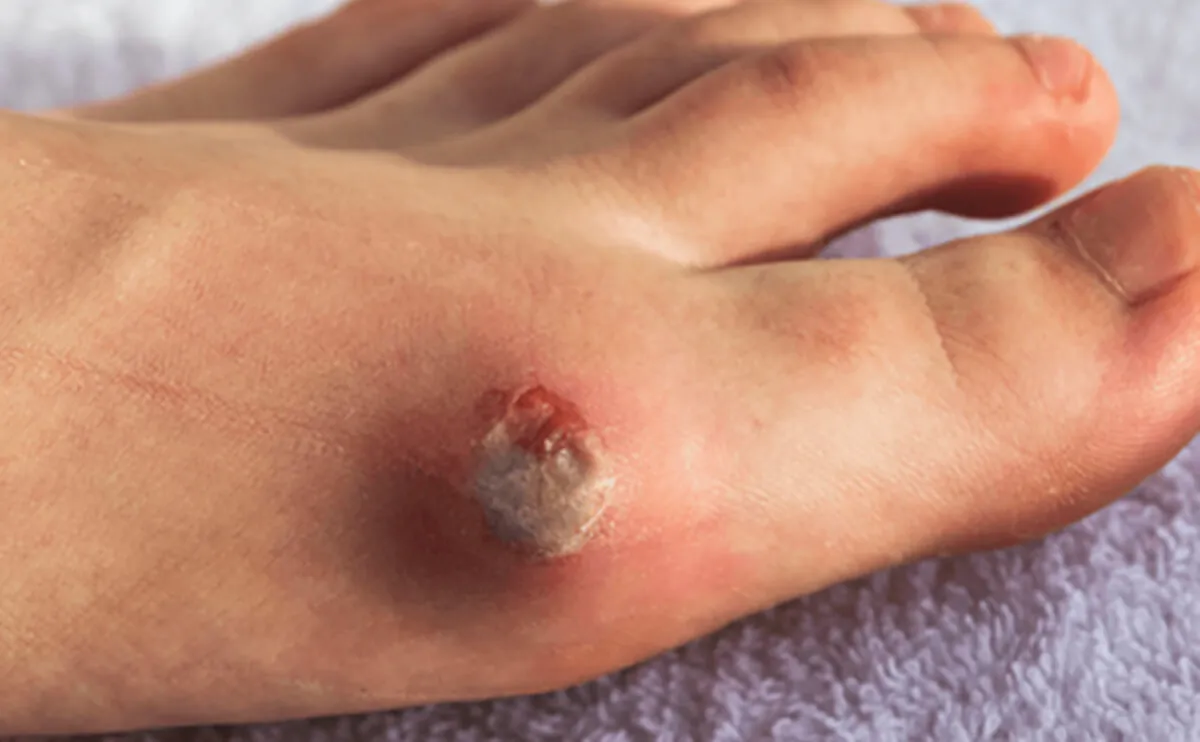 动脉性（缺血性）溃疡