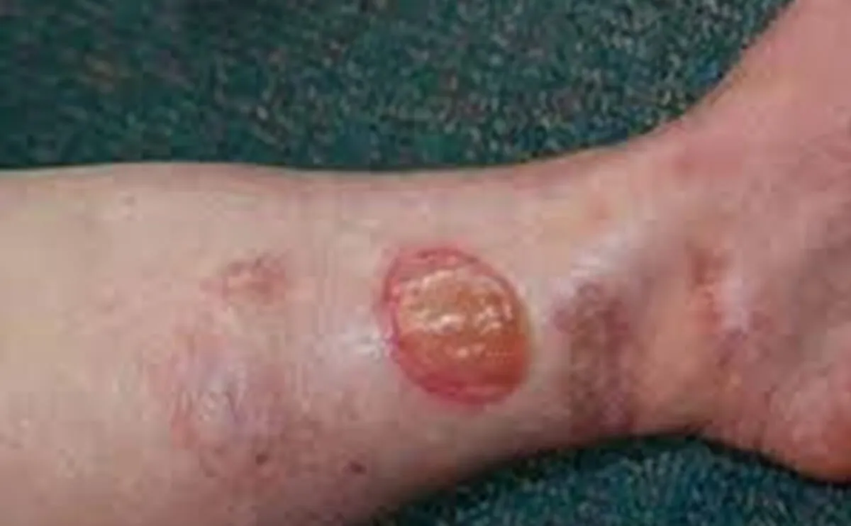 Autoimmune-Related Wounds