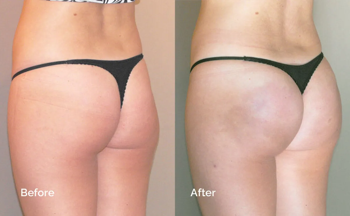 Buttock Augmentation