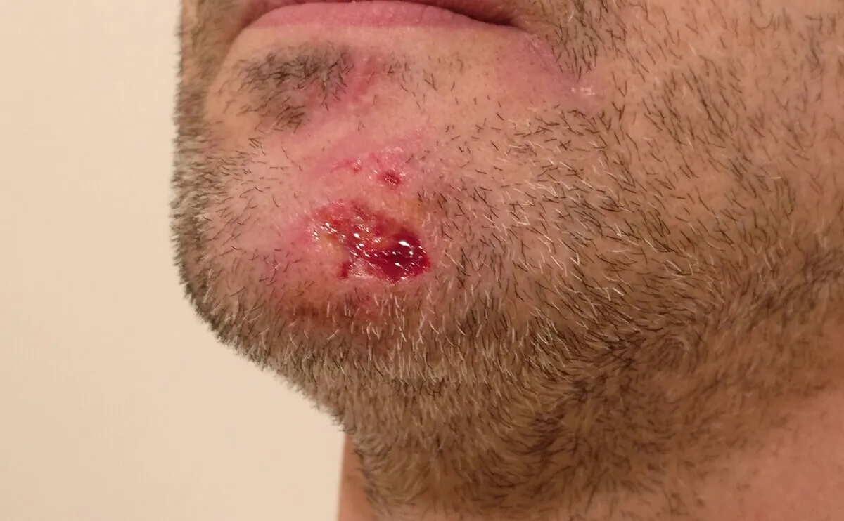 人为性/自伤性创面