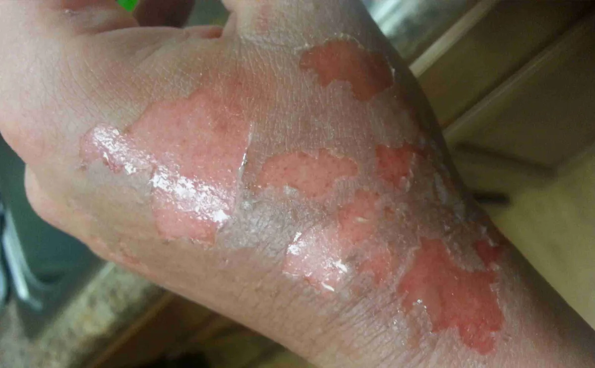 First‑Degree Burns