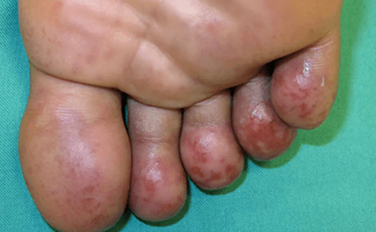 Frostbite &amp; Chillblains