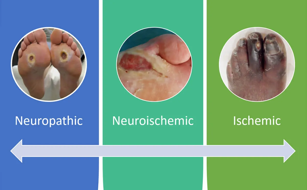 糖尿病缺血性溃疡