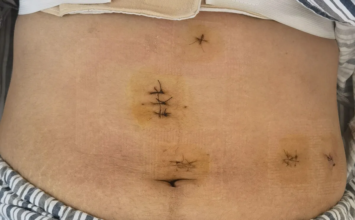 Laparoscopic Surgery