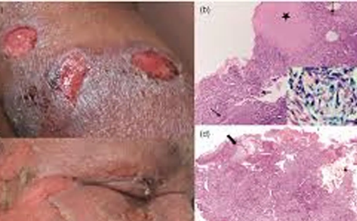 麻风病相关神经病变性溃疡