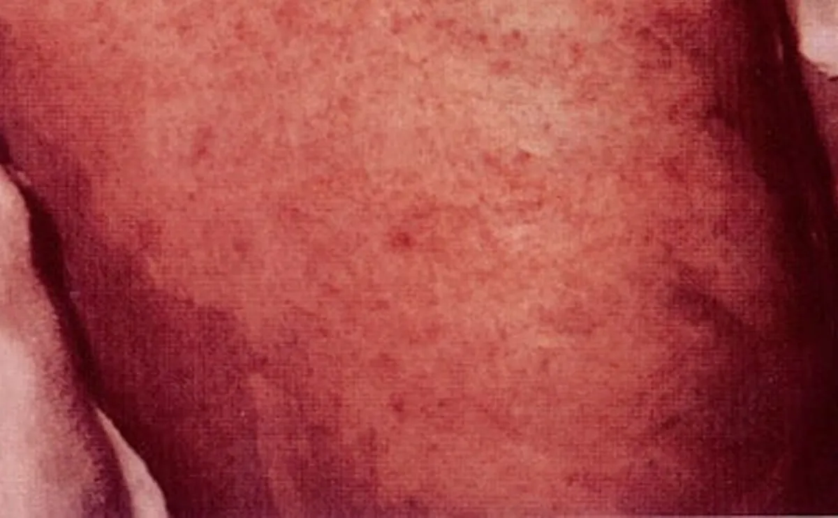 Malnutrition-Related Wounds