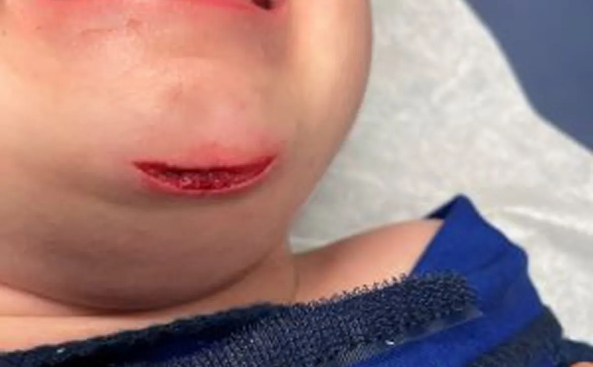 Minor Lacerations (Cuts)