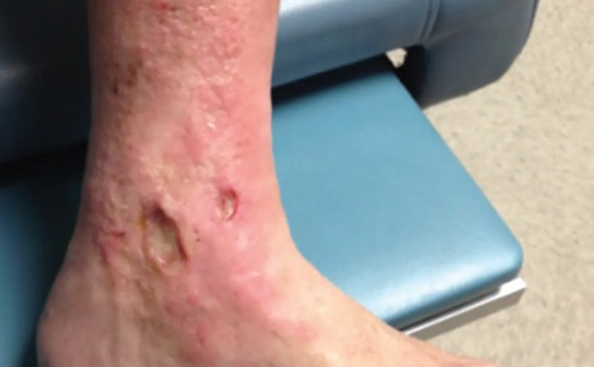 混合性动静脉溃疡