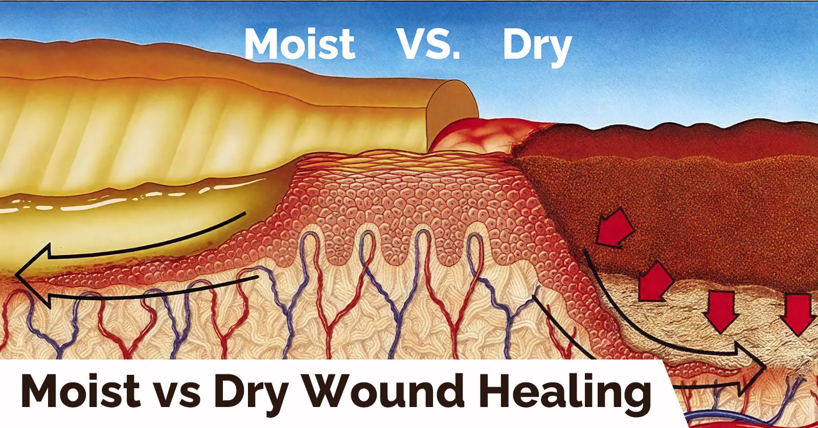 湿润伤口愈合 vs 干燥伤口愈合