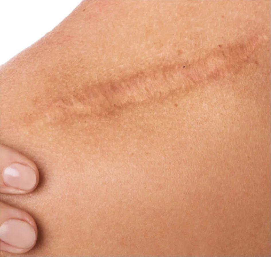 术后色素沉着与疤痕预防