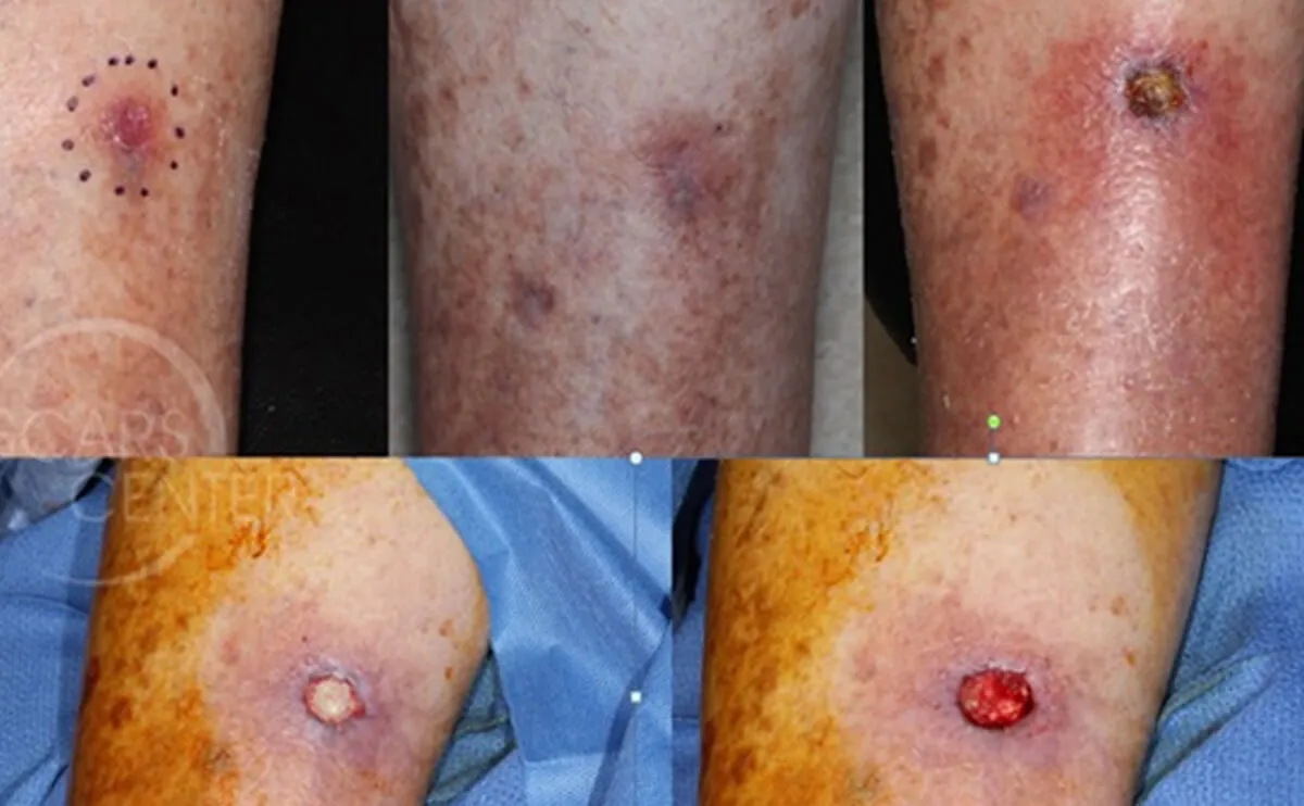 放射性损伤创面