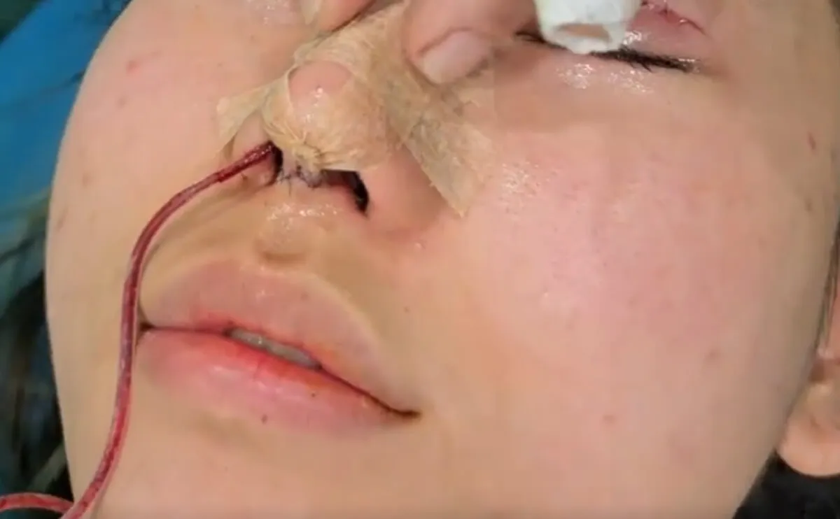 Rhinoplasty (nose reshaping) Rhinoplasty