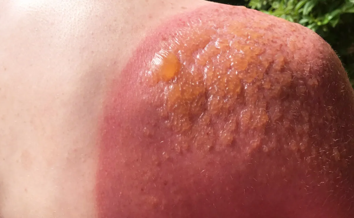 Second‑Degree Burns