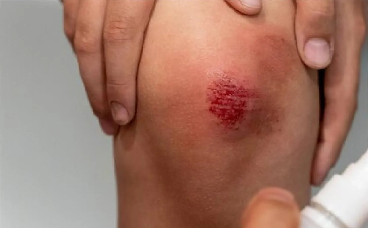 浅表割伤与擦伤