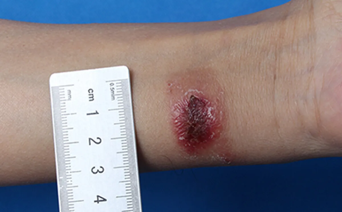 结核与非结核分枝杆菌感染