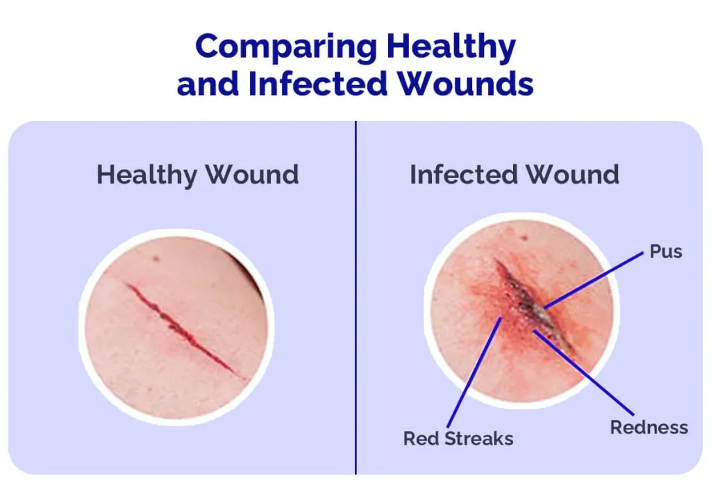 健康与感染伤口对比